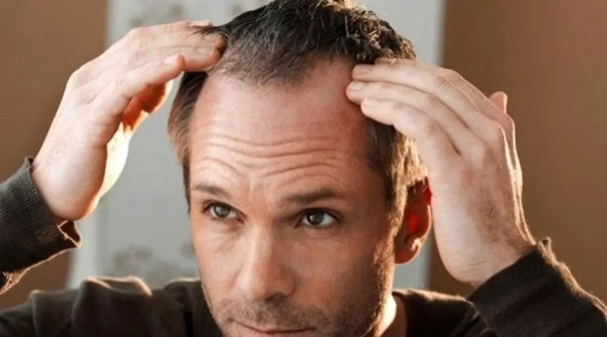 La calvicie no siempre significa pérdida total del cabello: diagnóstico temprano es clave