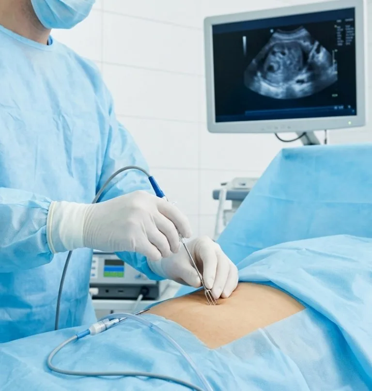 Nueva técnica de ablación por radiofrecuencia trata miomas uterinos sin cirugía mayor