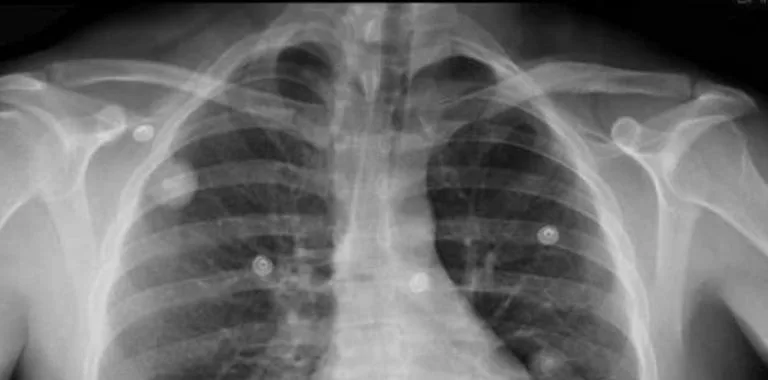 Papa León XIV se somete a cirugía por nódulo pulmonar detectado en controles médicos