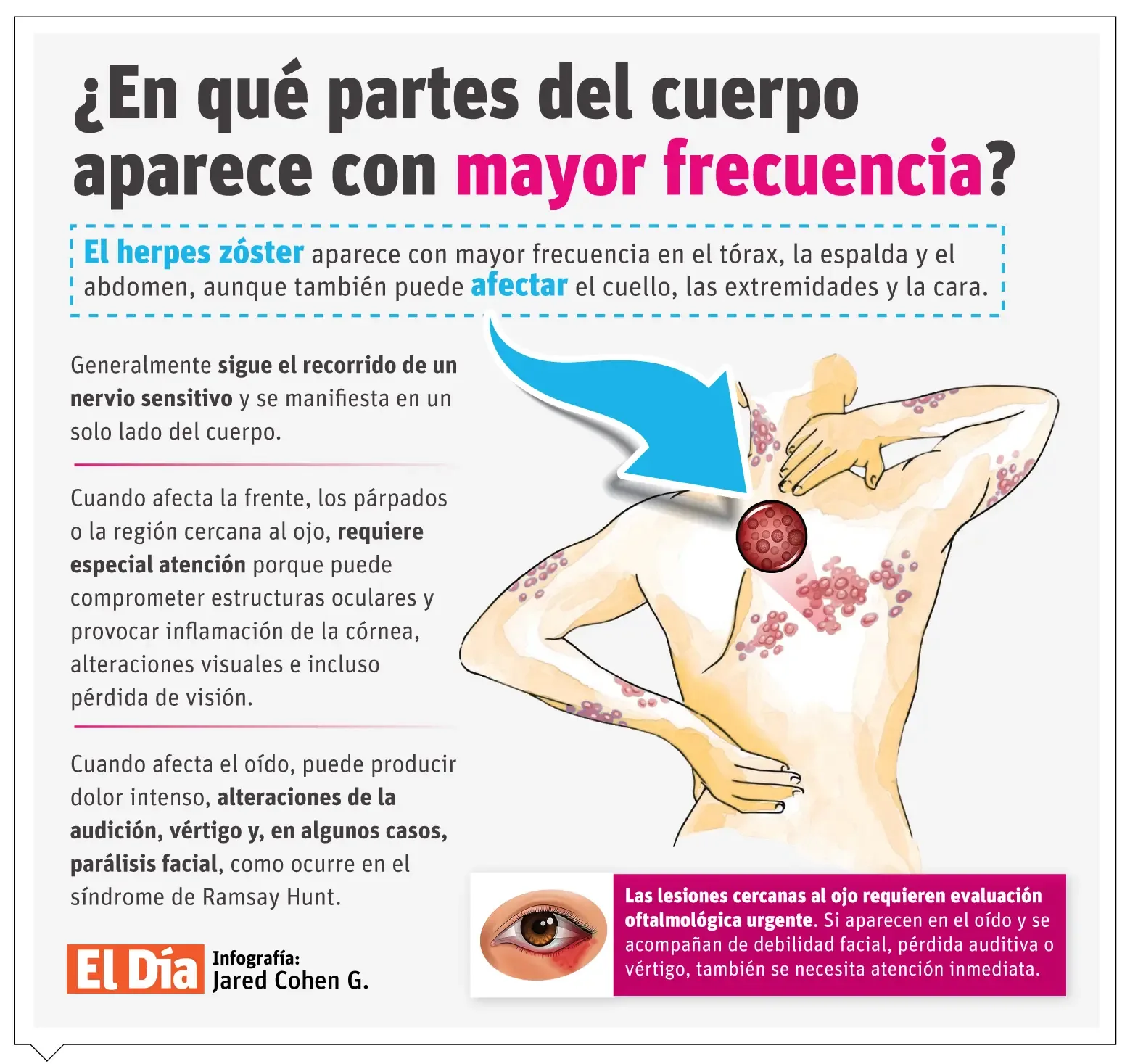 Herpes zóster: reactivación del virus de la varicela décadas después y su prevención