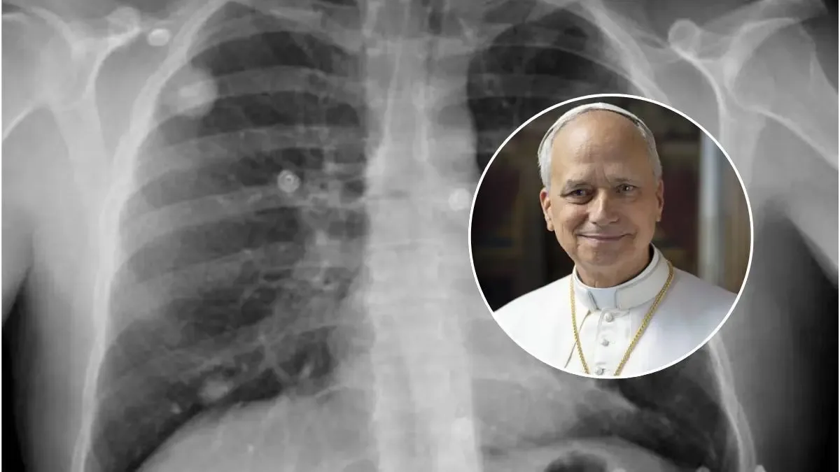 Adenocarcinoma pulmonar: el diagnóstico del papa León XIV y sus implicaciones médicas